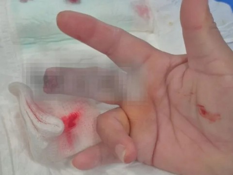 Una enfermera sufrió la amputación de parte de su dedo por un paciente exaltado en General Pinedo